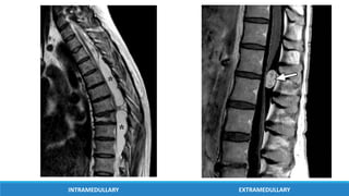 INTRAMEDULLARY EXTRAMEDULLARY
 