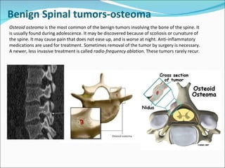 Benign Spinal tumors-osteoma Osteoid osteoma  is the most common of the benign tumors involving the bone of the spine. It is usually found during adolescence. It may be discovered because of scoliosis or curvature of the spine. It may cause pain that does not ease up, and is worse at night. Anti-inflammatory medications are used for treatment. Sometimes removal of the tumor by surgery is necessary. A newer, less invasive treatment is called  radio-frequency ablation . These tumors rarely recur.      