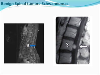 Benign Spinal tumors-Schwannomas 
