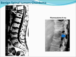 Benign Spinal tumors-Chordoma  Plasmacytoma X-ray 