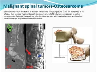 Malignant spinal tumors-Osteosarcoma  Osteosarcoma  occurs most often in children, adolescents, and young adults. Males are more likely to be affected than females. Treatment usually consists of removal of the tumor when possible as well as chemotherapy. Radiation therapy is not effective. Older persons with Paget's disease or who have had radiation therapy may develop this type of tumor.    