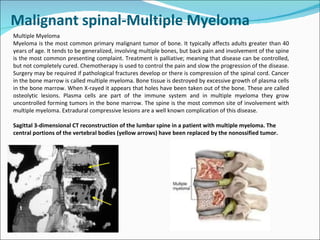 Spinal tumors lecture Slide 11