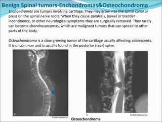 Spinal tumors lecture Slide 17