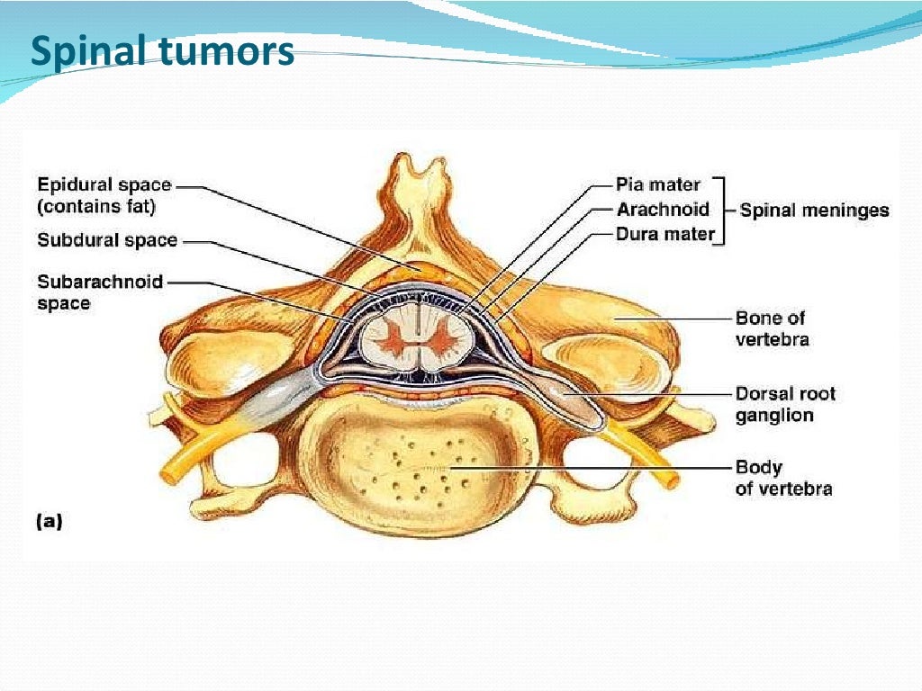 Spinal tumors lecture