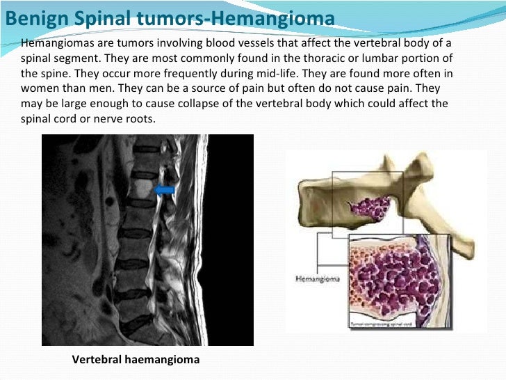 Spinal tumors lecture