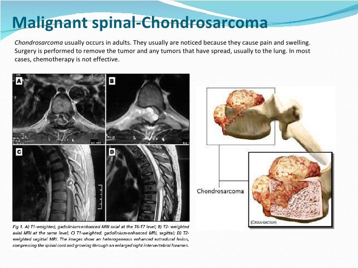 Spinal tumors lecture