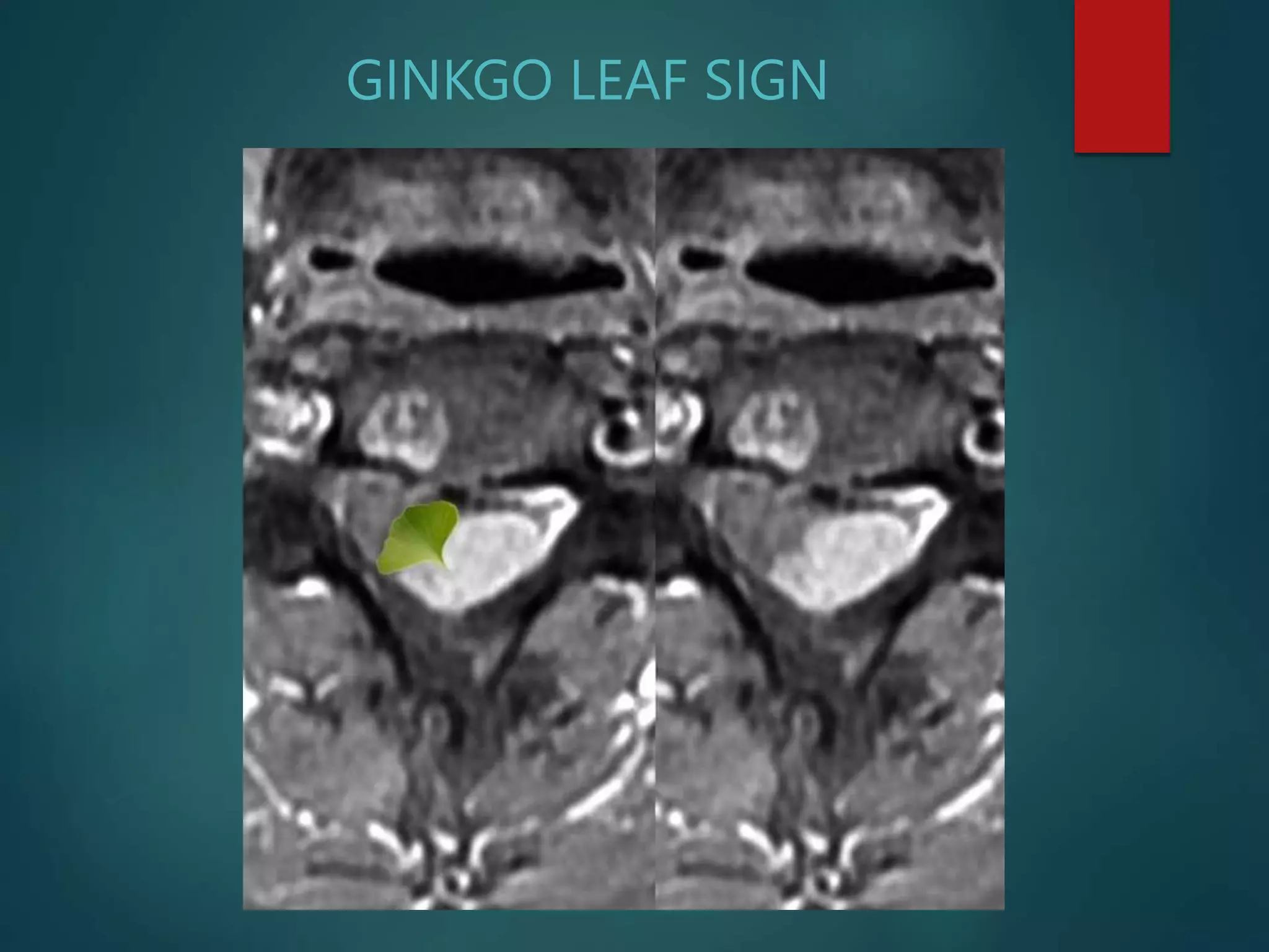 imaging-of-spinal-tumors-pptx