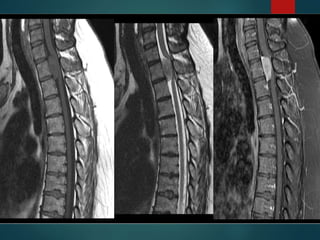 IMAGING OF SPINAL TUMORS | PPTX