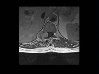 IMAGING OF SPINAL TUMORS | PPTX