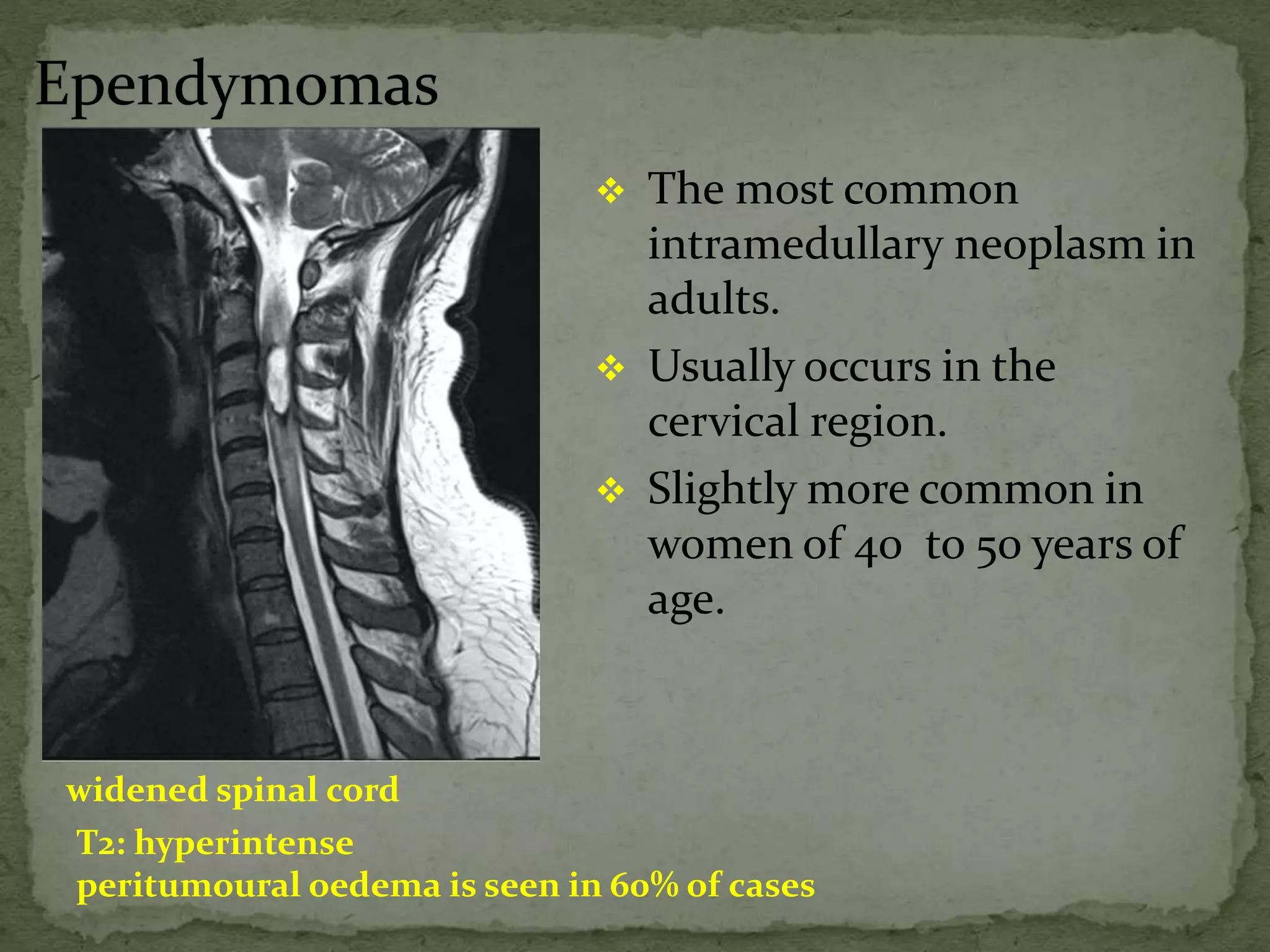  The most common
intramedullary neoplasm in
adults.
 Usually occurs in the
cervical region.
 Slightly more common in
women of 40 to 50 years of
age.
widened spinal cord
T2: hyperintense
peritumoural oedema is seen in 60% of cases
 