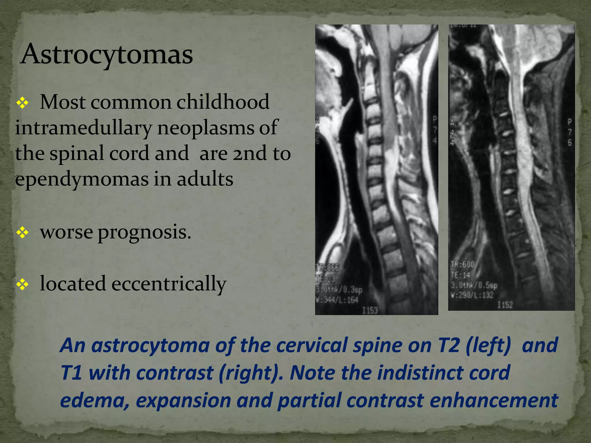  Most common childhood
intramedullary neoplasms of
the spinal cord and are 2nd to
ependymomas in adults
 worse prognosis.
 located eccentrically
An astrocytoma of the cervical spine on T2 (left) and
T1 with contrast (right). Note the indistinct cord
edema, expansion and partial contrast enhancement
 