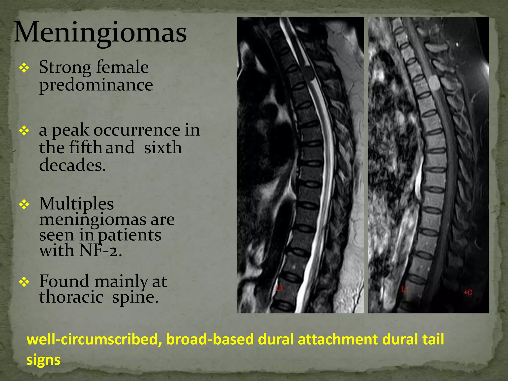  Strong female
predominance
 a peak occurrence in
the fifthand sixth
decades.
 Multiples
meningiomas are
seen inpatients
with NF-2.
 Found mainly at
thoracic spine.
well-circumscribed, broad-based dural attachment dural tail
signs
 