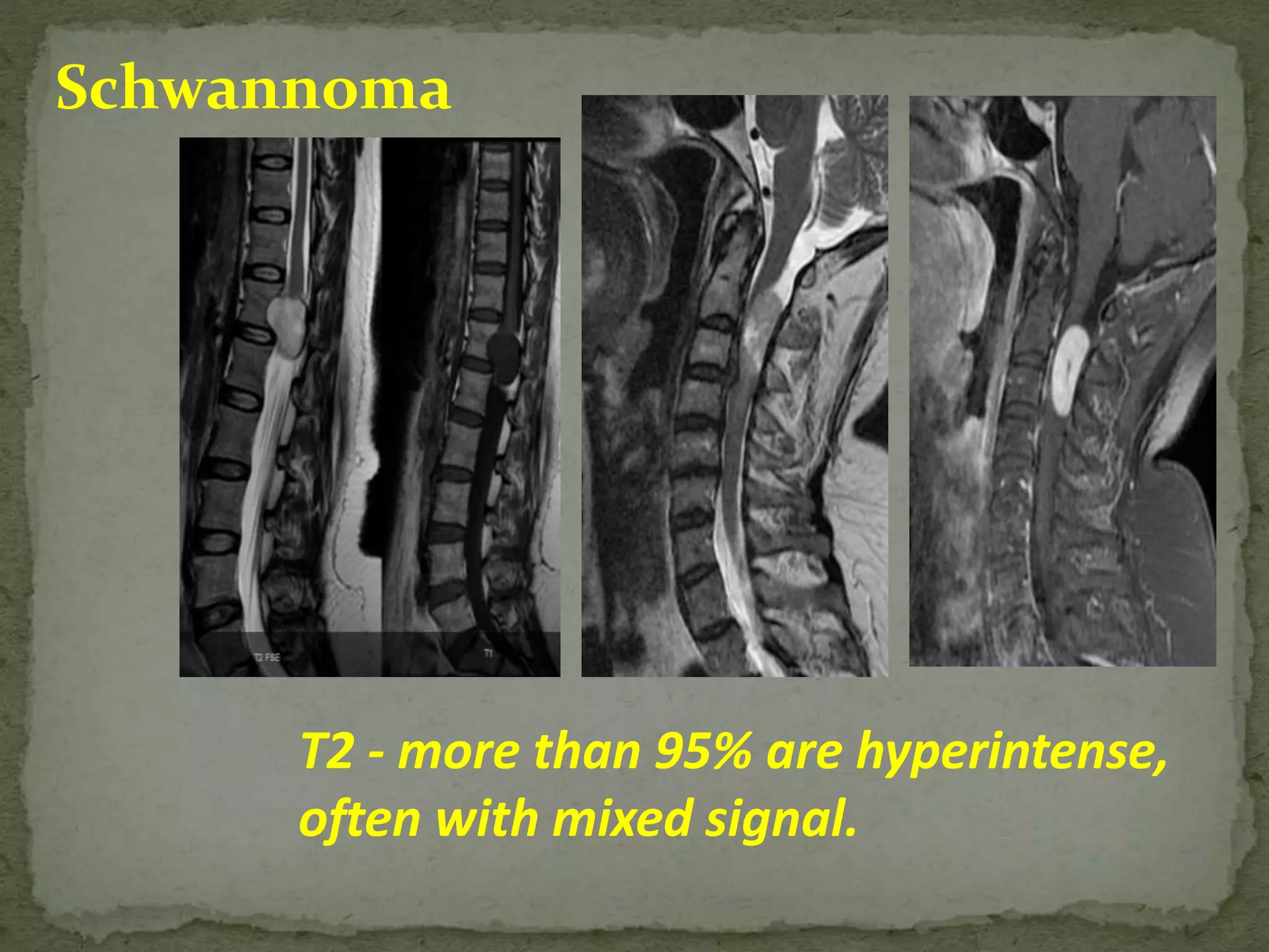 Schwannoma
T2 - more than 95% are hyperintense,
often with mixed signal.
 
