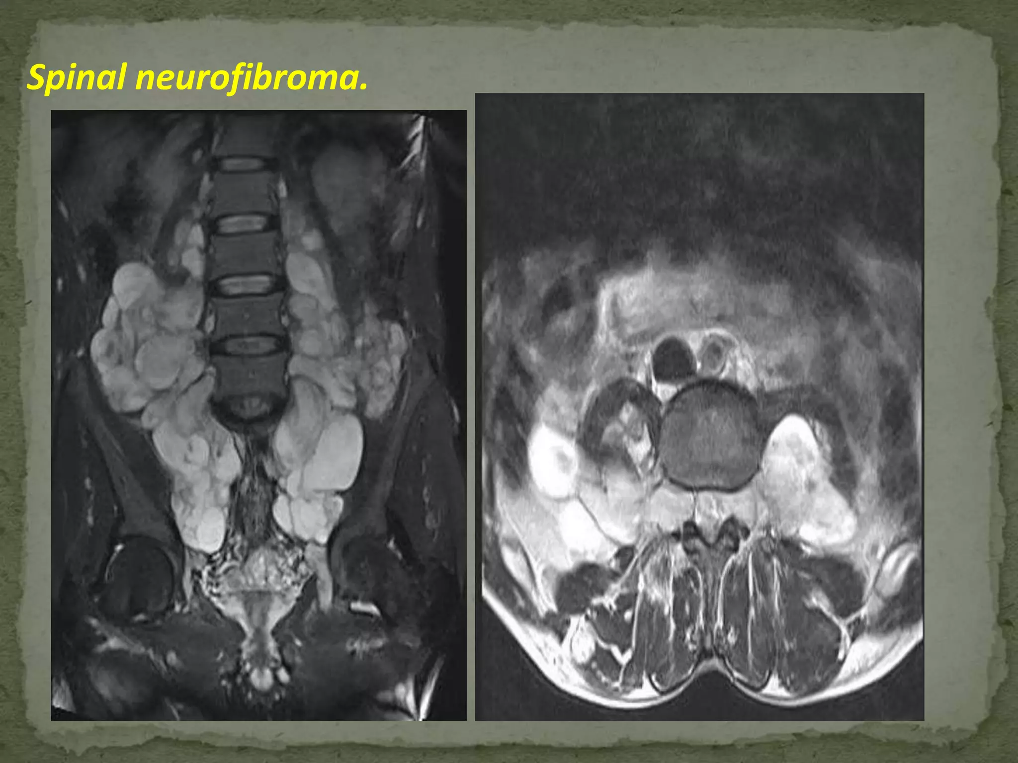 Spinal neurofibroma.
 