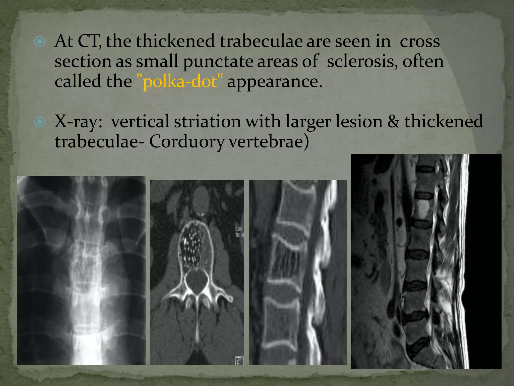  At CT, the thickened trabeculae are seen in cross
section as small punctate areas of sclerosis, often
called the "polka-dot" appearance.
 X-ray: vertical striation with larger lesion & thickened
trabeculae- Corduory vertebrae)
 