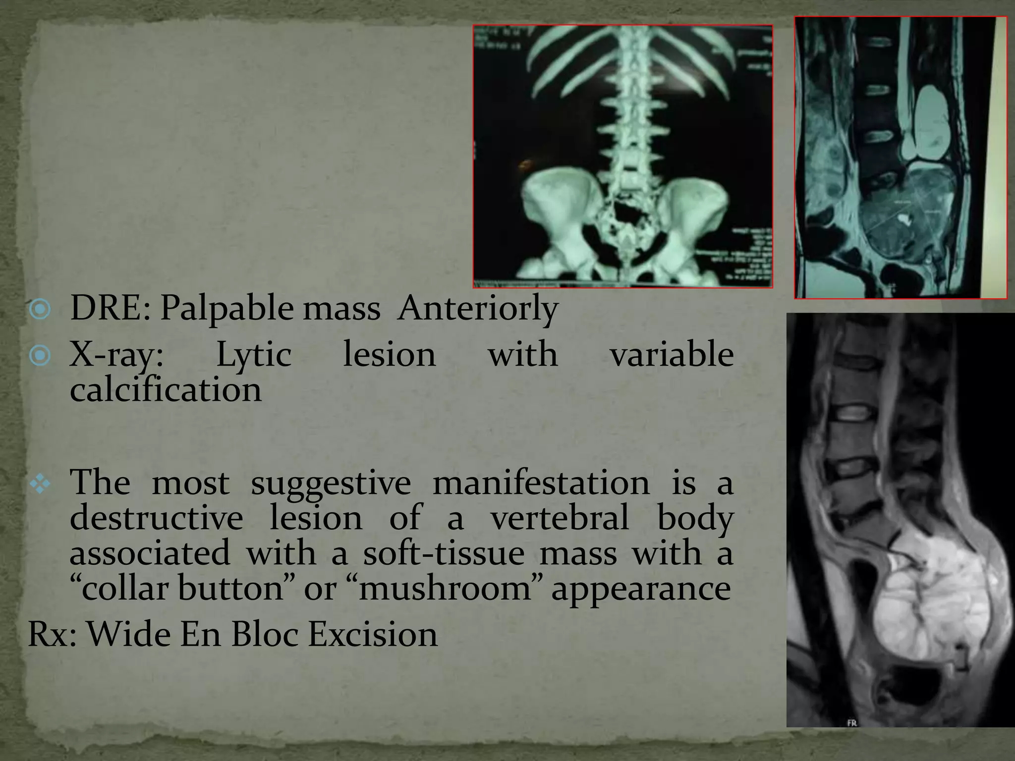  DRE: Palpable mass Anteriorly
 X-ray: Lytic lesion with variable
calcification
 The most suggestive manifestation is a
destructive lesion of a vertebral body
associated with a soft-tissue mass with a
“collar button” or “mushroom” appearance
Rx: Wide En Bloc Excision
 