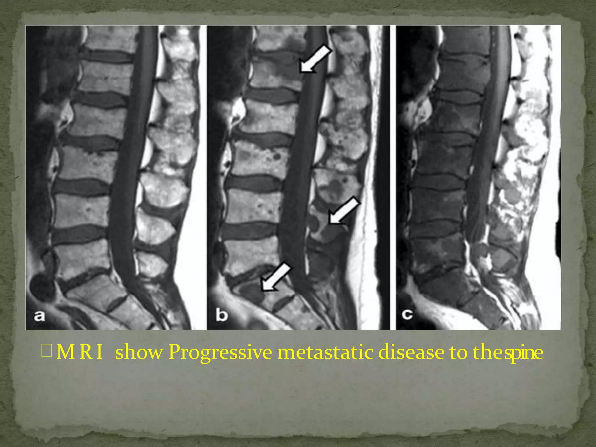  M R I show Progressive metastatic disease to thespine
 