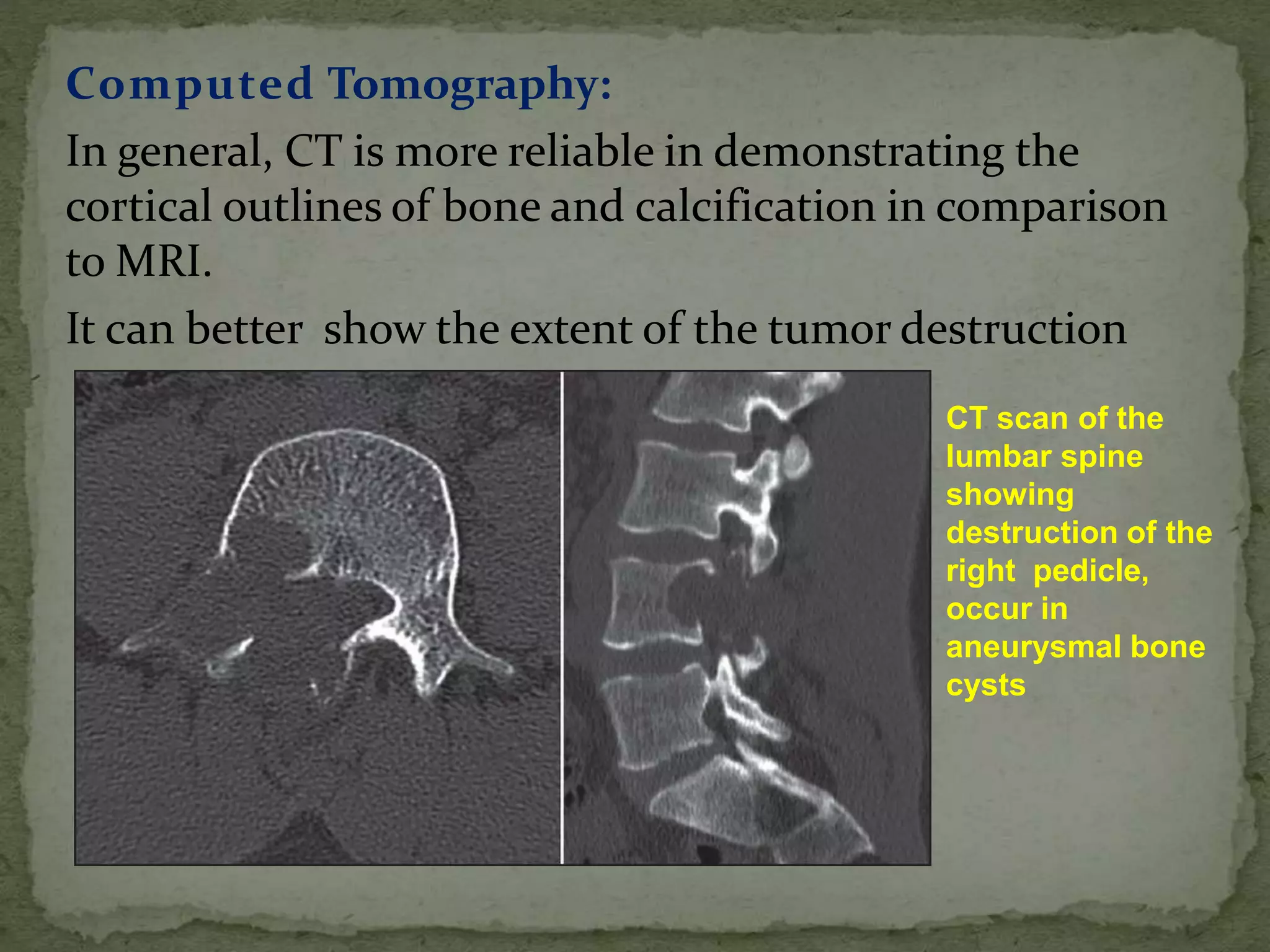 Computed Tomography:
In general, CT is more reliable in demonstrating the
cortical outlines of bone and calcification in comparison
to MRI.
It can better show the extent of the tumor destruction
CT scan of the
lumbar spine
showing
destruction of the
right pedicle,
occur in
aneurysmal bone
cysts
 