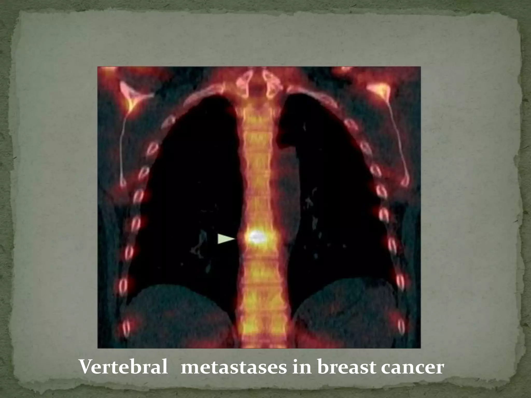 Vertebral metastases in breast cancer
 