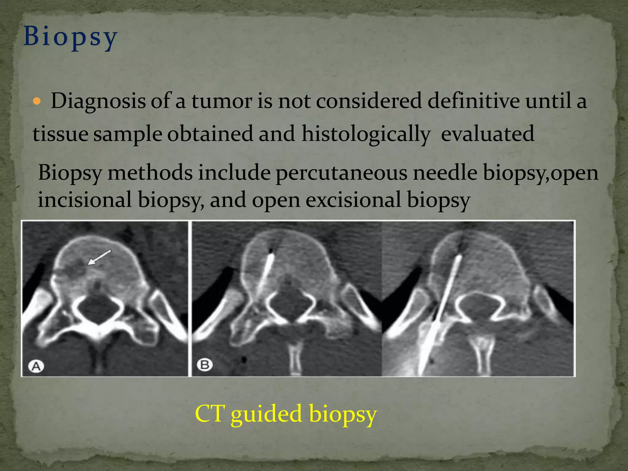  Diagnosis of a tumor is not considered definitive until a
tissue sample obtained and histologically evaluated
CT guided biopsy
 