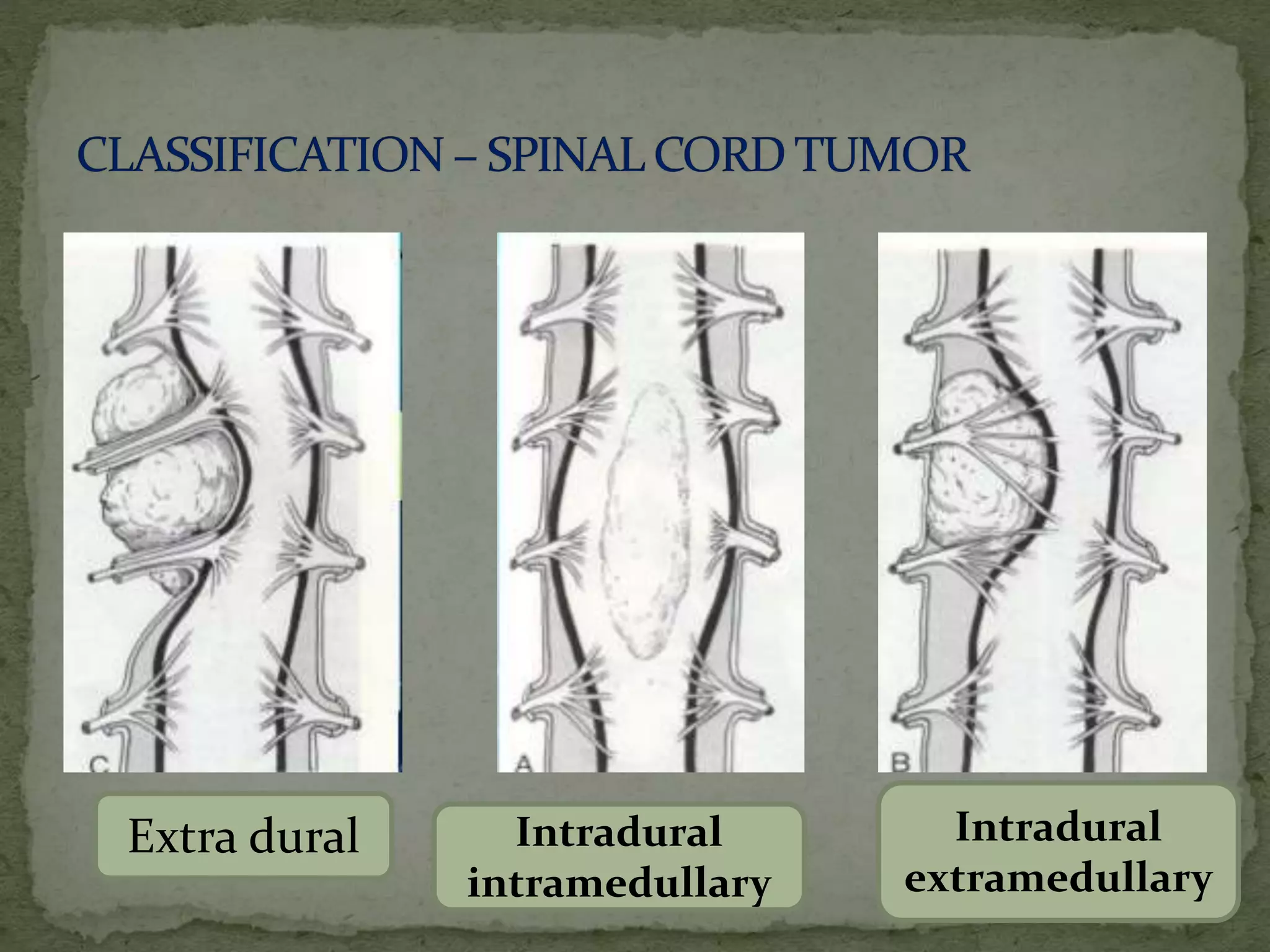 Extra dural Intradural
intramedullary
Intradural
extramedullary
 