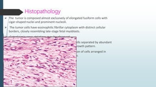 Histopathology
 Encapsulated tumor that shows two microscopic patterns in varying amounts:
 ANTONI A – streaming fascicl...