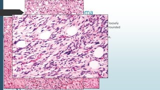 Histopathology
 Well circumscribed lesions with variable microscopic appearance.
 The cellular end of this spectrum corr...
