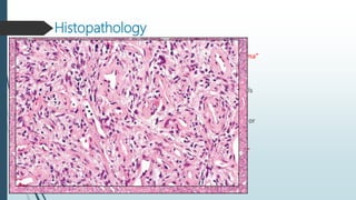Histopathology
The Earliest (patch) stage – a flat lesion characterized by a proliferation of miniature
vessels surroundin...