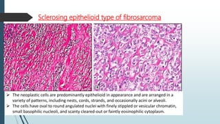 Histopathology
 Basic to all MFH - proliferation of pleomorphic spindle shaped cells
showing fibroblastic morphology. Abn...