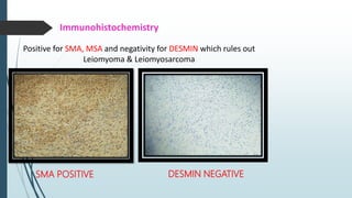Immunohistochemistry
 SMA
 MSA POSITIVE
 DESMIN
 ANAPLASTIC LYMPHOMA KINASE-1 (ALK-1) - 35 TO 60 % POSITIVE
SMA
 