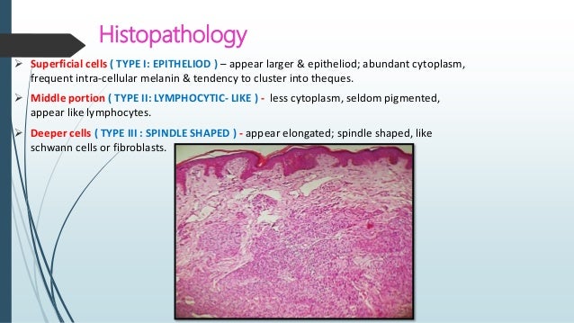 Spindle Cell Lesions Of Head Neck