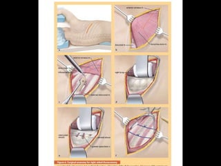 Surgery 6th year, Tutorial (Dr. Khalid Shokor Mahmood)