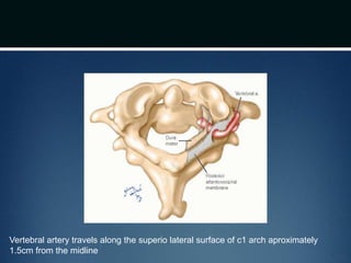 Vertebral artery travels along the superio lateral surface of c1 arch aproximately
1.5cm from the midline
 