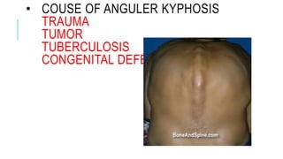 • COUSE OF ANGULER KYPHOSIS
TRAUMA
TUMOR
TUBERCULOSIS
CONGENITAL DEFECTS
 