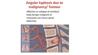 Affection or collapse of vertebral
body benign malignant or
metastatic can Couse spinal
deformity
 