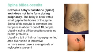 is when a baby's backbone (spine)
arch does not fully form during
pregnancy. The baby is born with a
small gap in the bones of the spine.
Spina bifida occulta is common and
happens in about 1 out of 10 people.
Usually, spina bifida occulta causes no
health problems.
Usually a tuft of hair or hyperpigmented
area over spine is indicative
In more sever case a menigiocele or
mylocele is present
 