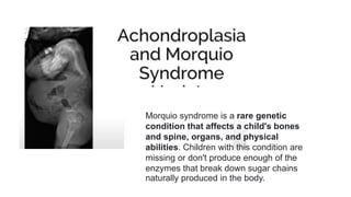Morquio syndrome is a rare genetic
condition that affects a child's bones
and spine, organs, and physical
abilities. Children with this condition are
missing or don't produce enough of the
enzymes that break down sugar chains
naturally produced in the body.
 