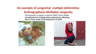 Arthrogryposis multiplex congenita (AMC) refers to the
development of multiple joint contractures affecting
two or more areas of the body prior to birth
 