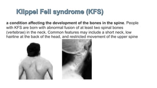 a condition affecting the development of the bones in the spine. People
with KFS are born with abnormal fusion of at least two spinal bones
(vertebrae) in the neck. Common features may include a short neck, low
hairline at the back of the head, and restricted movement of the upper spine
 