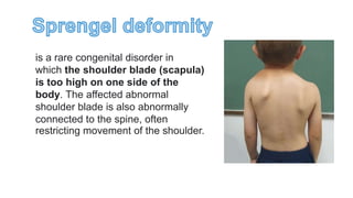 is a rare congenital disorder in
which the shoulder blade (scapula)
is too high on one side of the
body. The affected abnormal
shoulder blade is also abnormally
connected to the spine, often
restricting movement of the shoulder.
 