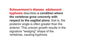 Scheuermann's disease adolescent
kyphosis describes a condition where
the vertebrae grow unevenly with
respect to the sagittal plane; that is, the
posterior angle is often greater than the
anterior. This uneven growth results in the
signature "wedging" shape of the
vertebrae, causing kyphosis.
 