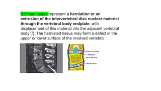 Schmorl nodes represent a herniation or an
extrusion of the intervertebral disc nuclear material
through the vertebral body endplate, with
displacement of this material into the adjacent vertebral
body [2]. The herniated tissue may form a defect in the
upper or lower surface of the involved vertebra.
 