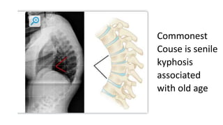 Commonest
Couse is senile
kyphosis
associated
with old age
 