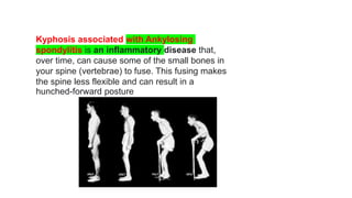 Kyphosis associated with Ankylosing
spondylitis is an inflammatory disease that,
over time, can cause some of the small bones in
your spine (vertebrae) to fuse. This fusing makes
the spine less flexible and can result in a
hunched-forward posture
 