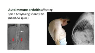 affecting
spine Ankylosing spondylitis
(bamboo spine)
 