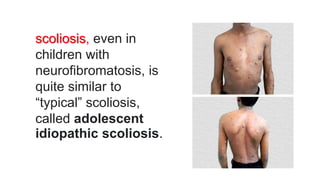 scoliosis, even in
children with
neurofibromatosis, is
quite similar to
“typical” scoliosis,
called adolescent
idiopathic scoliosis.
 