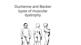 Duchenne and Becker
types of muscular
dystrophy
 