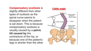 Compensatory scoliosis is
slightly different from other
types of scoliosis as the
spinal curve seems to
disappear when the patient
is sat down. This is because
compensatory scoliosis is
usually caused by a pelvic
tilt caused by the
contracture of the hip, or
because one of the patient's
legs is shorter than the other
Cobbs angle
 