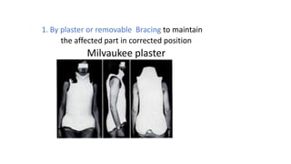 1. By plaster or removable Bracing to maintain
the affected part in corrected position
Milvaukee plaster
 