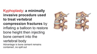 Kyphoplasty: a minimally
invasive procedure used
to treat vertebral
compression fractures by
inflating a balloon to restore
bone height then injecting
bone cement into the
vertebral body
Advantage is bone cement remains
contained ,no spill out
 
